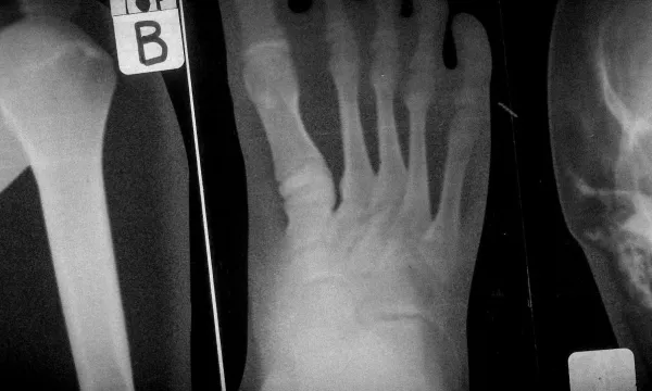 an x-ray of a foot